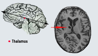 thalamus